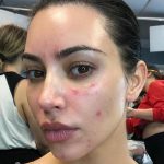 Lupus: La Enfermedad de Kim Kardashian